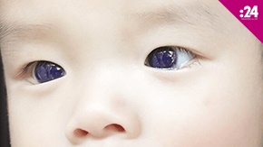عينا طفل تتحول من البني للأزرق.. ما السبب؟